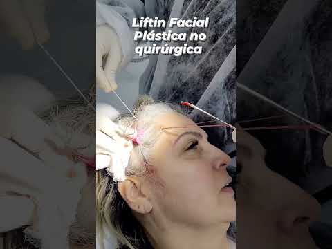 El arte de rejuvenecer: Explorando el lifting facial