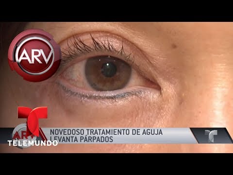Una guía detallada para levantar los párpados caídos sin cirugía